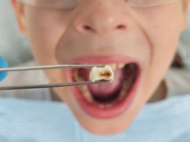 Best Emergency Wisdom Tooth Extraction in Powells Crossroads, TN